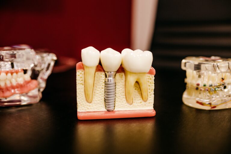 Implantes